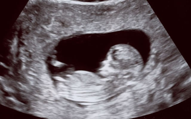 12 Haftalık Bebek Ultrason Görüntüleri