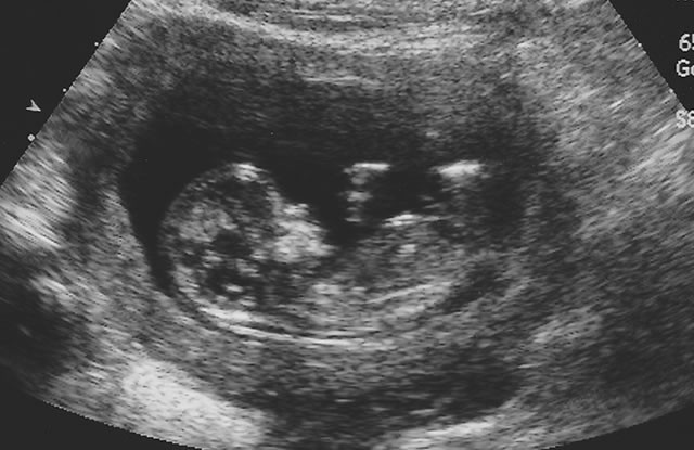 12 Haftalık Erkek - Kız Bebek Ultrason Görüntüsü