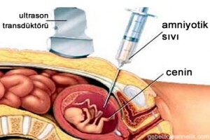 Amniyosentez Testi Nedir?